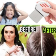 স্টেইনলেস স্টিলের উকুন অপসারণের চিরুনি, Stainless Steel Lice Removal Comb one PCS